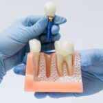The Very Best Countries To Have Got Dental Implants Abroad