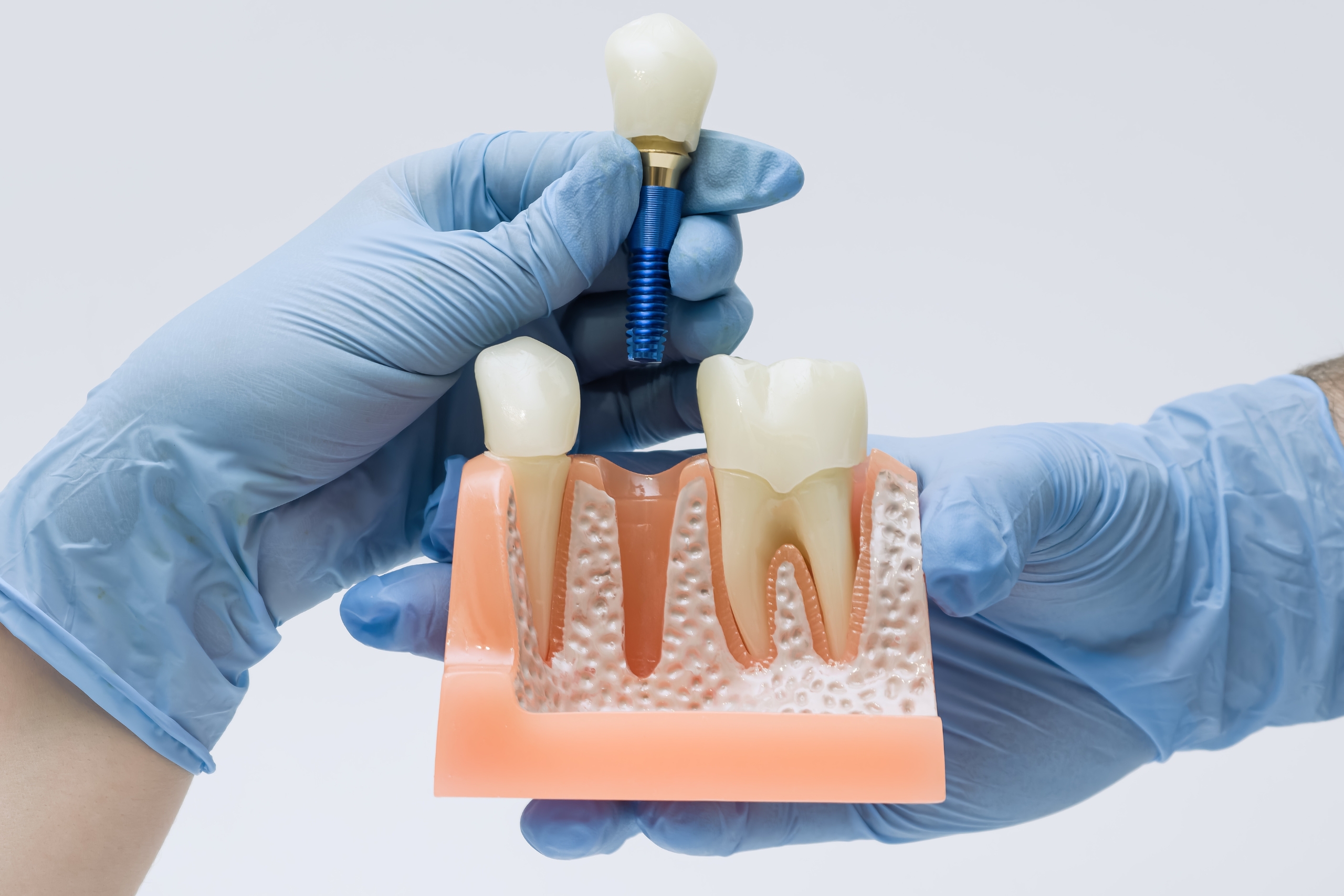 The Very Best Countries To Have Got Dental Implants Abroad